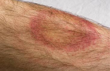 Skin Lesion from Lyme Disease