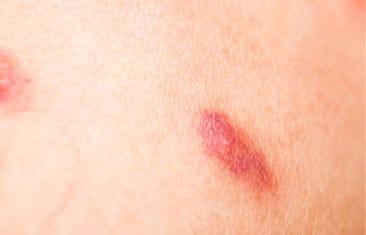 A skin rash from Typhus